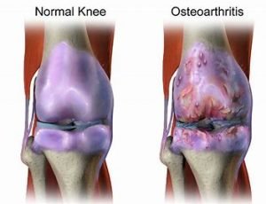 Osteoarthritis