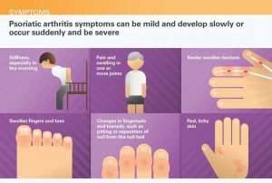 Symptoms of Psoriatic Arthritis