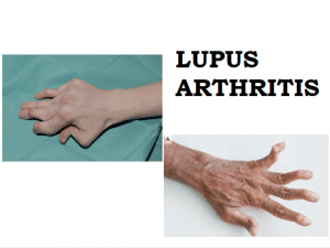 lupus arthrtis