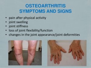 osteoarthritis symptoms