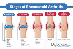 Rheumatoid Arthritis