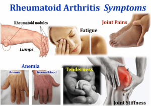 rheumatoid-arthritis-symptoms