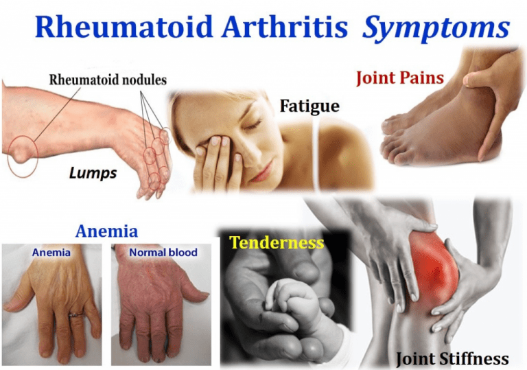 Most Common Types Of Arthritis